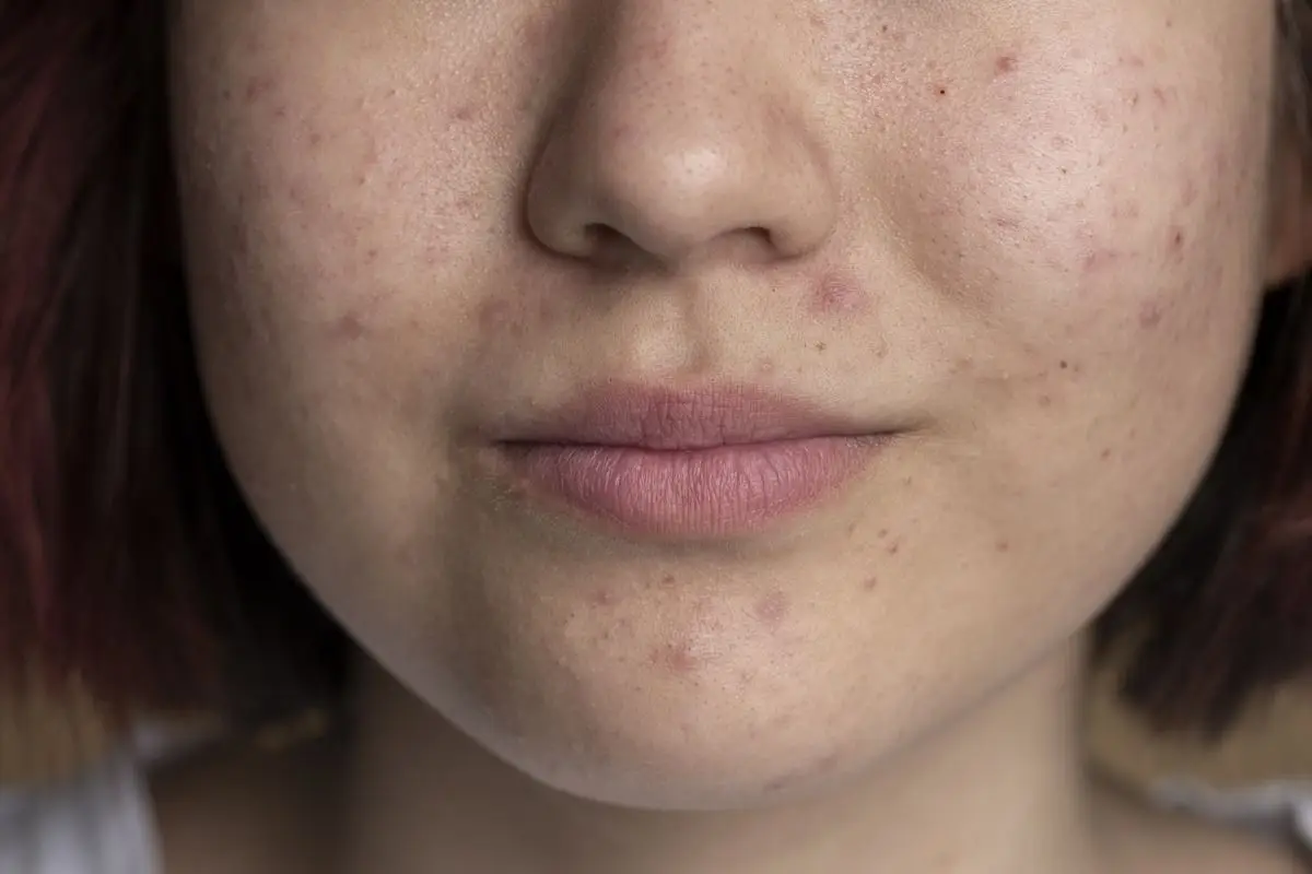 Tak perlu coba banyak skincare, ini cara efektif hilangkan tiny bumps di wajah dalam 10 menit
