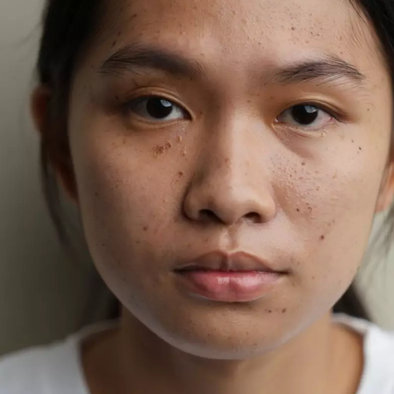 5 Masker alami penghilang komedo paling ampuh, bisa bikin kulit mulus seketika