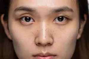 Cara menghilangkan komedo putih dan hitam di hidung, cuma butuh 10 menit