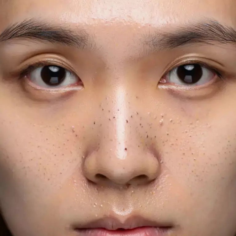 Cara menghilangkan komedo putih dan hitam di hidung, cuma butuh 10 menit