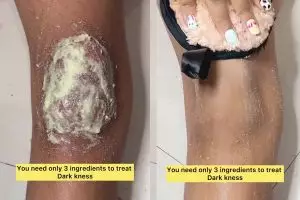 Lutut hitam dan kasar bukan lagi masalah, begini cara cepat mengatasinya dalam 20 menit