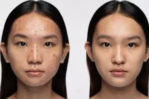 Bekas jerawat hilang dalam 7 hari, ini 3 cara skincare ampuh yang wajib kamu coba