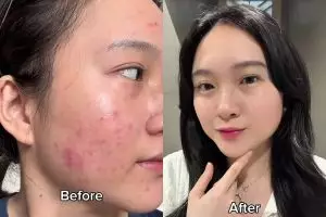 Tak perlu skincare mahal, cewek ini buktikan 1 bahan dapur bisa ampuh hilangkan jerawat dan bekasnya