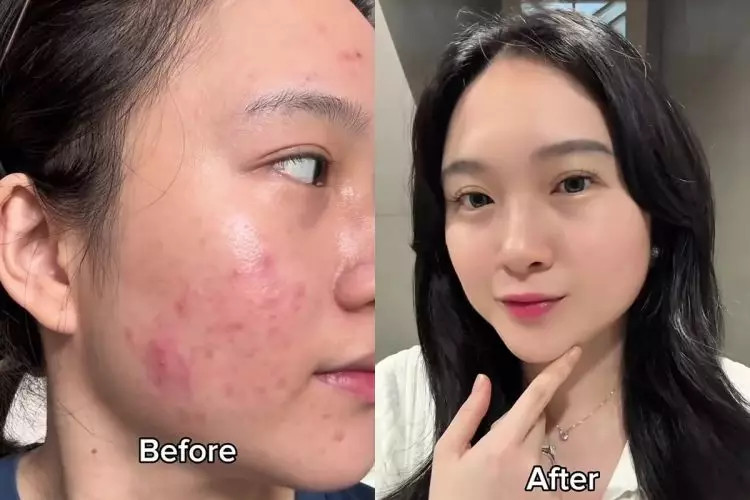 Tak perlu skincare mahal, cewek ini buktikan 1 bahan dapur bisa ampuh hilangkan jerawat dan bekasnya