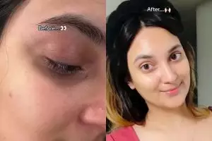 Mata panda bikin wajah lesu? Ini cara menghilangkannya pakai eye cream dari 1 jenis kacang-kacangan