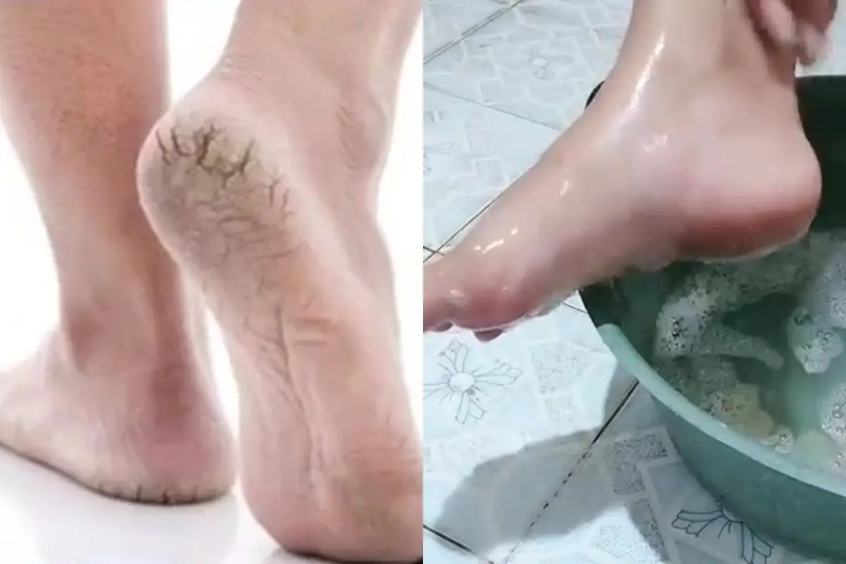 Punya tumit kering dan pecah-pecah? Begini cara mengatasinya cuma direndam pakai 2 bahan dapur ini