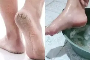 Punya tumit kering dan pecah-pecah? Begini cara mengatasinya cuma direndam pakai 2 bahan dapur ini