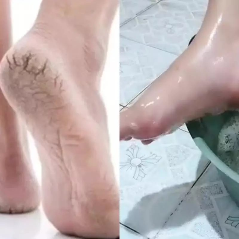 Punya tumit kering dan pecah-pecah? Begini cara mengatasinya cuma direndam pakai 2 bahan dapur ini
