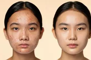 5 Cara menghilangkan jerawat dengan cepat dan aman, hasil terlihat sejak hari pertama