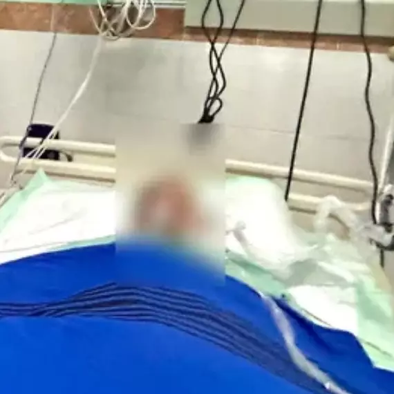 5 Kronologi bocah usia 11 tahun meninggal usai digigit ular weling, 1 bulan dirawat melawan bisa