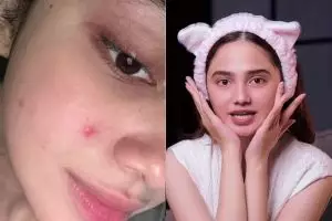 Tak pernah pakai acne patch, begini cara Syifa Hadju atasi jerawat di wajah agar cepat kempis