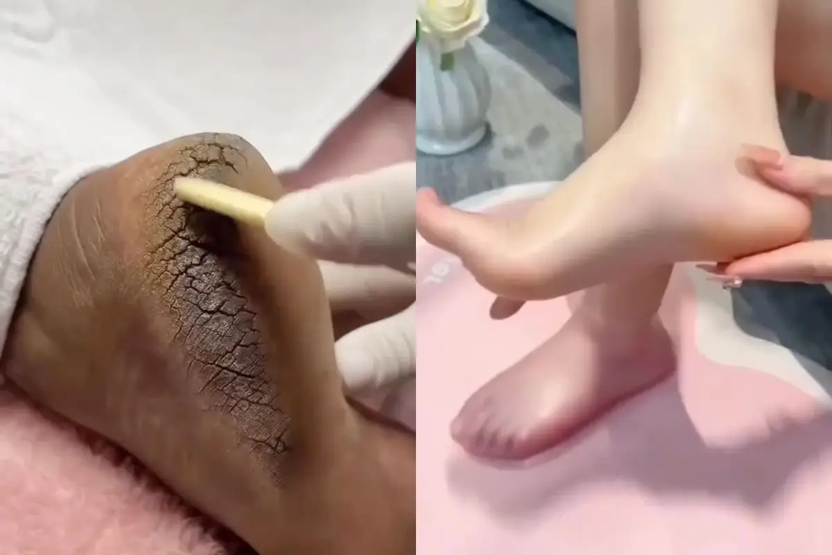 Tumit kapalan sampai pecah-pecah? Scrub dari 2 bahan dapur ini ampuh mengatasinya tanpa bikin iritasi