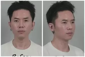 Nabung Rp500 juta demi bisa permak wajah, Rafael Tan sebut oplas sebagai investasi jangka panjang