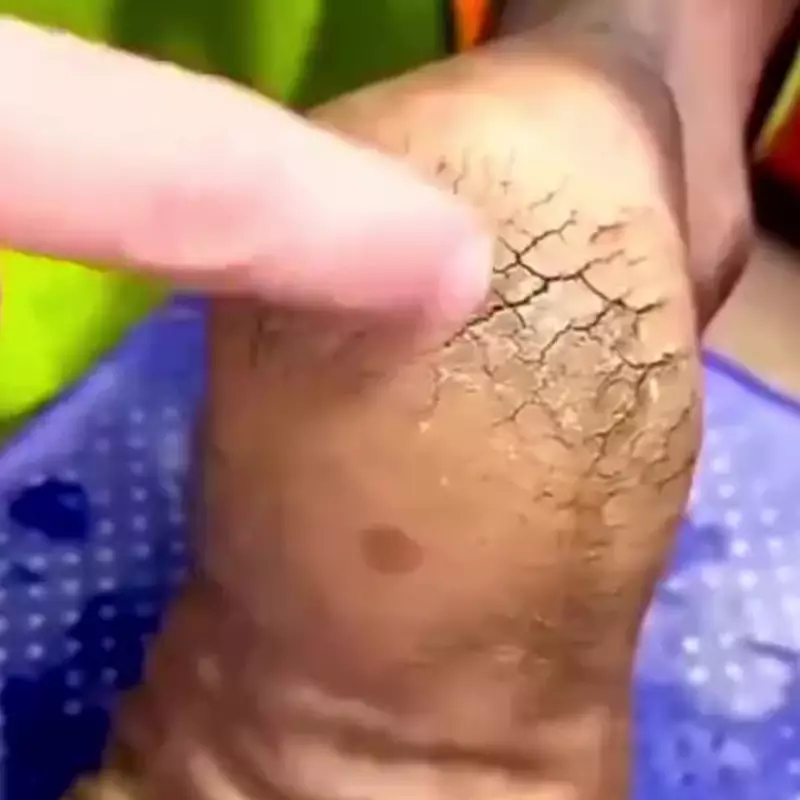 Cuma butuh semalam! Ini cara efektif hilangkan tumit pecah-pecah agar halus lagi dengan 2 bahan dapur