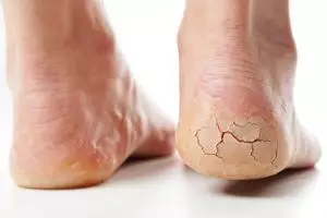 Tumit pecah-pecah bikin iritasi? Bahan pemanis ini bisa ampuh mengatasinya tanpa bikin perih