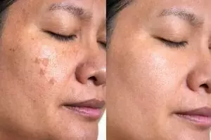 Banyak flek hitam di wajah bikin nggak pede? Pakai trik ini buat cerahkan dengan 1 jenis buah