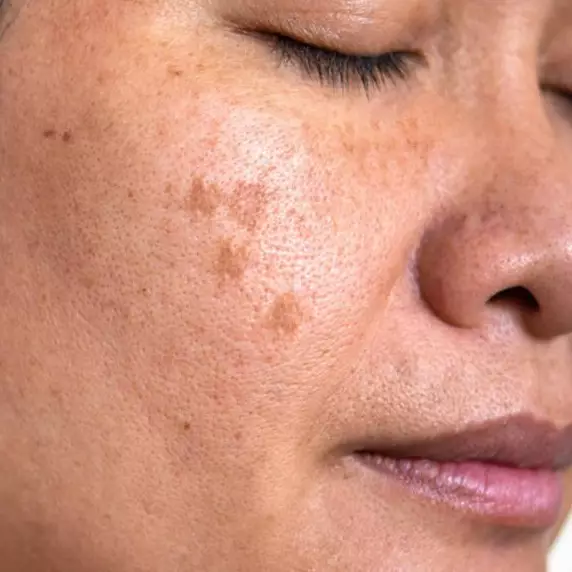 Banyak flek hitam di wajah bikin nggak pede? Pakai trik ini buat cerahkan dengan 1 jenis buah