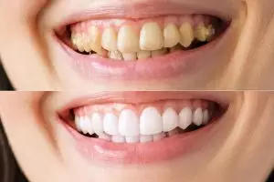 Cara memutihkan gigi kuning dengan 1 bahan rempah, tak perlu veneer