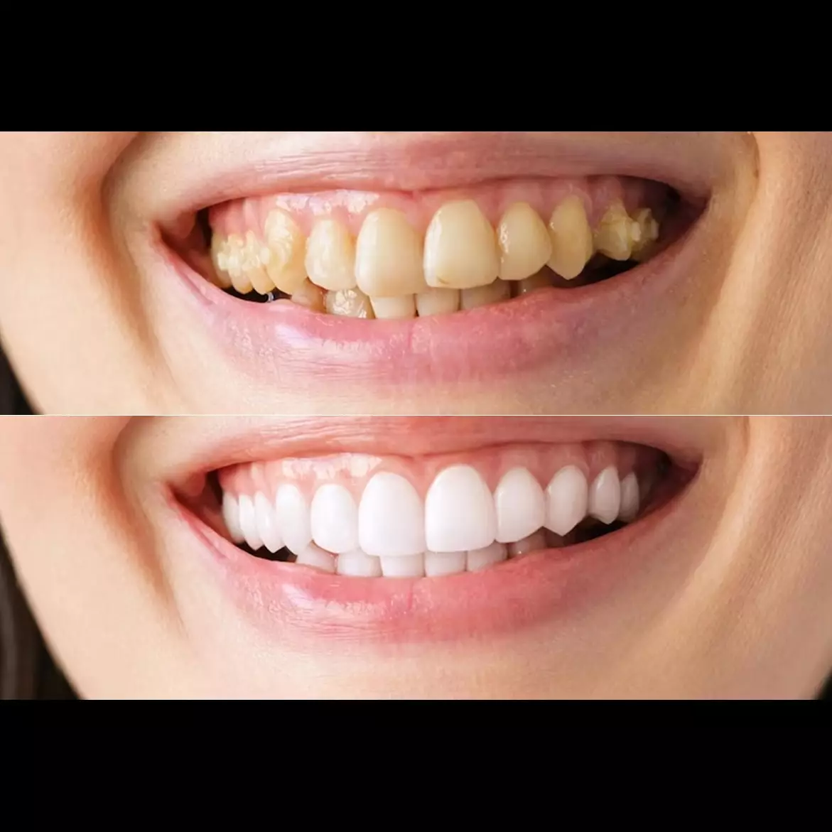 Cara memutihkan gigi kuning dengan 1 bahan rempah, tak perlu veneer