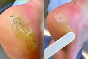 Cara bikin tumit kapalan dan pecah-pecah jadi mulus lagi pakai lotion dari racikan 3 bahan alami ini