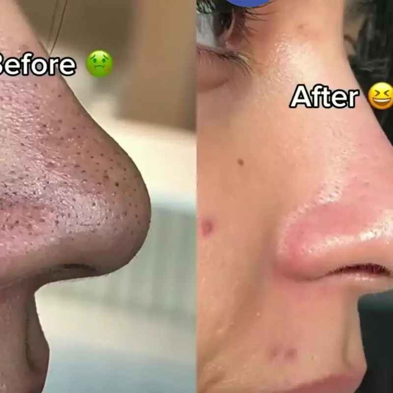 Pori-pori kotor penuh komedo hitam? Coba bersihkan dengan buah 1 ini, komedo auto hilang dalam sekejap