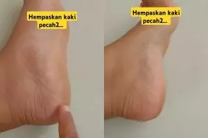 Tak ada lagi tumit kasar dan pecah-pecah, ini trik ampuh menghempaskannya dengan 1 bumbu dapur