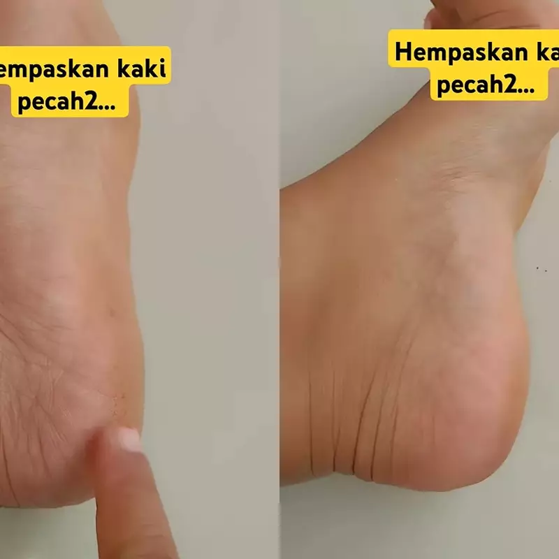 Tak ada lagi tumit kasar dan pecah-pecah, ini trik ampuh menghempaskannya dengan 1 bumbu dapur