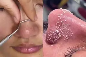 Cara mengecilkan pori-pori ini bikin wajah tampak lebih mulus dan bersih, cukup pakai 3 bahan dapur