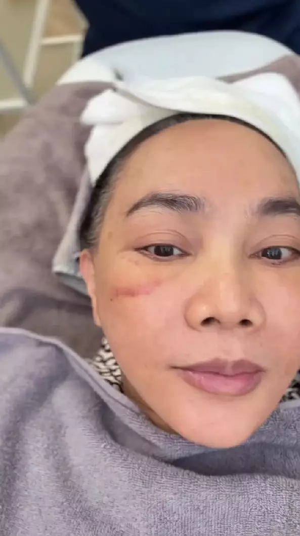 Dewi Gita rogoh ratusan juta demi oplas © Instagram