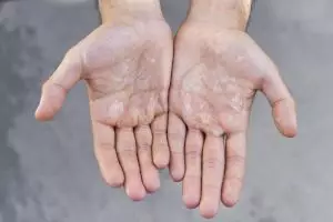 Tak perlu keluar duit banyak buat beli minyak zaitun, ini cara simpel atasi tangan kasar pakai 1 buah