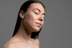 10 Serum untuk wajah berjerawat harga di bawah Rp 200 ribu