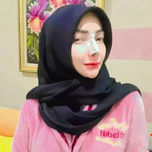 7 Potret Roro Fitria jalani operasi plastik hidung, ngaku demi kesehatan
