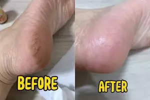 Tumit pecah-pecah bikin kaki perih? Coba haluskan dengan buah ini biar mulus lagi, bahannya sederhana