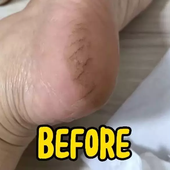 Tumit pecah-pecah bikin kaki perih? Coba haluskan dengan buah ini biar mulus lagi, bahannya sederhana