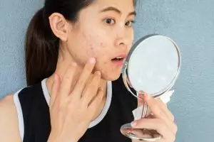 Apa itu jerawat pasir dan bagaimana cara menghilangkannya? Ini penjelasan dan 5 cara mengatasinya