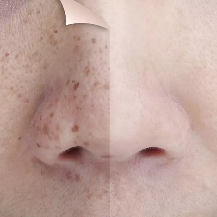 Tepung ini ampuh pudarkan flek hitam akibat hiperpigmentasi meski tanpa yoghurt, caranya mudah banget