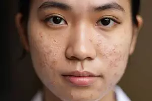 Wajah bebas gradakan, ini cara menghilangkan beruntusan pakai 1 bahan pemanis, auto mulus seketika