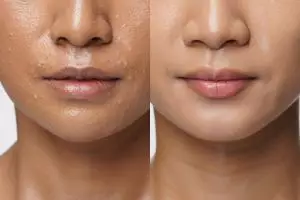 10 Cara mencerahkan bibir hitam secara alami, glowing dalam 7 hari