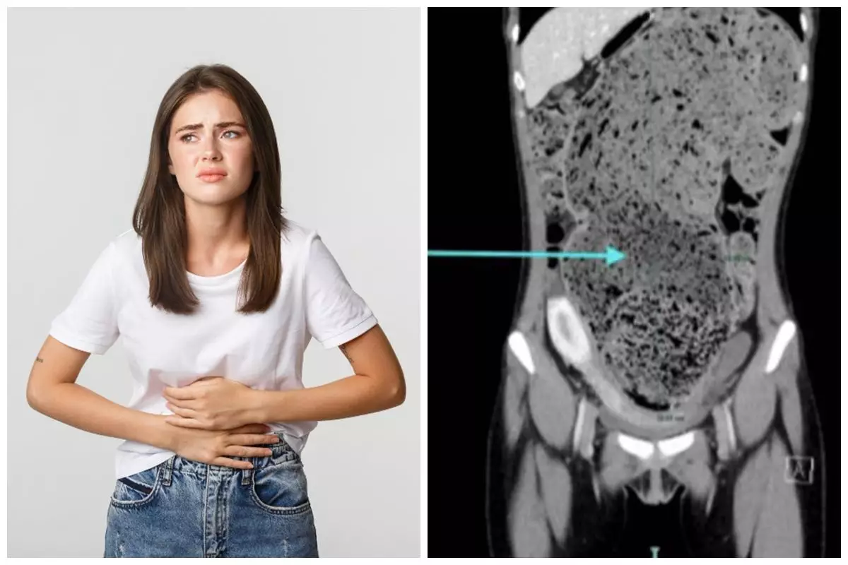 Kisah wanita tak BAB 4 bulan, dokter ungkap kondisi perutnya bak dipenuhi tanah liat