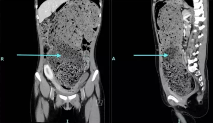 Wanita tidak BAB 4 bulan isi perut seperti tanah liat © 2025 brilio.net