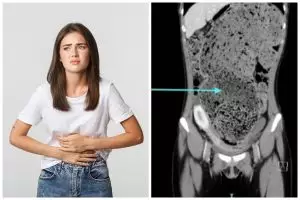 Kisah wanita tak BAB 4 bulan, dokter ungkap kondisi perutnya bak dipenuhi tanah liat