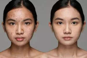 4 Cara pilih foundation sesuai jenis jerawat, hasil makeup jadi lebih natural