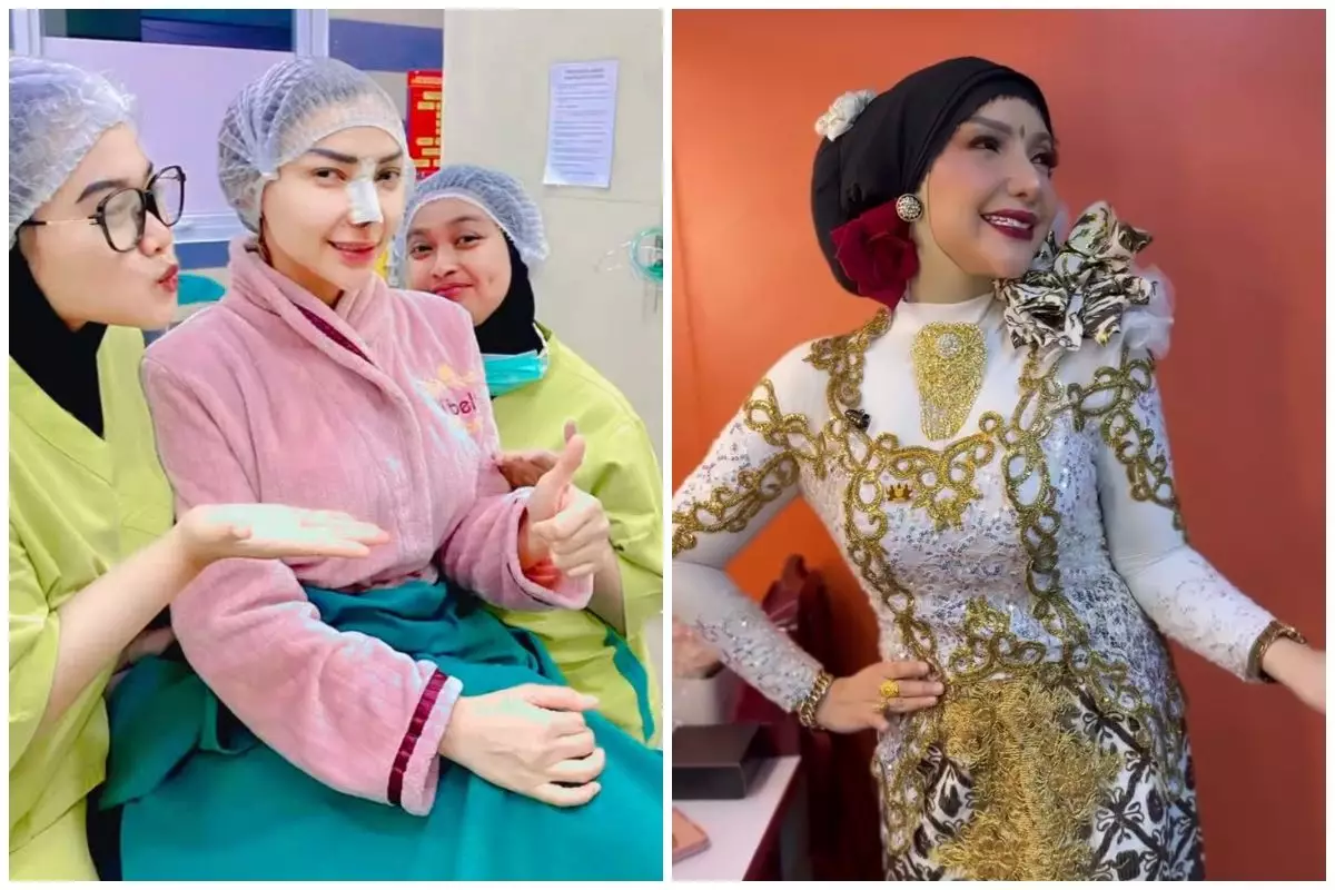 9 Potret terbaru Roro Fitria usai operasi plastik bagian hidung, dipuji makin cantik