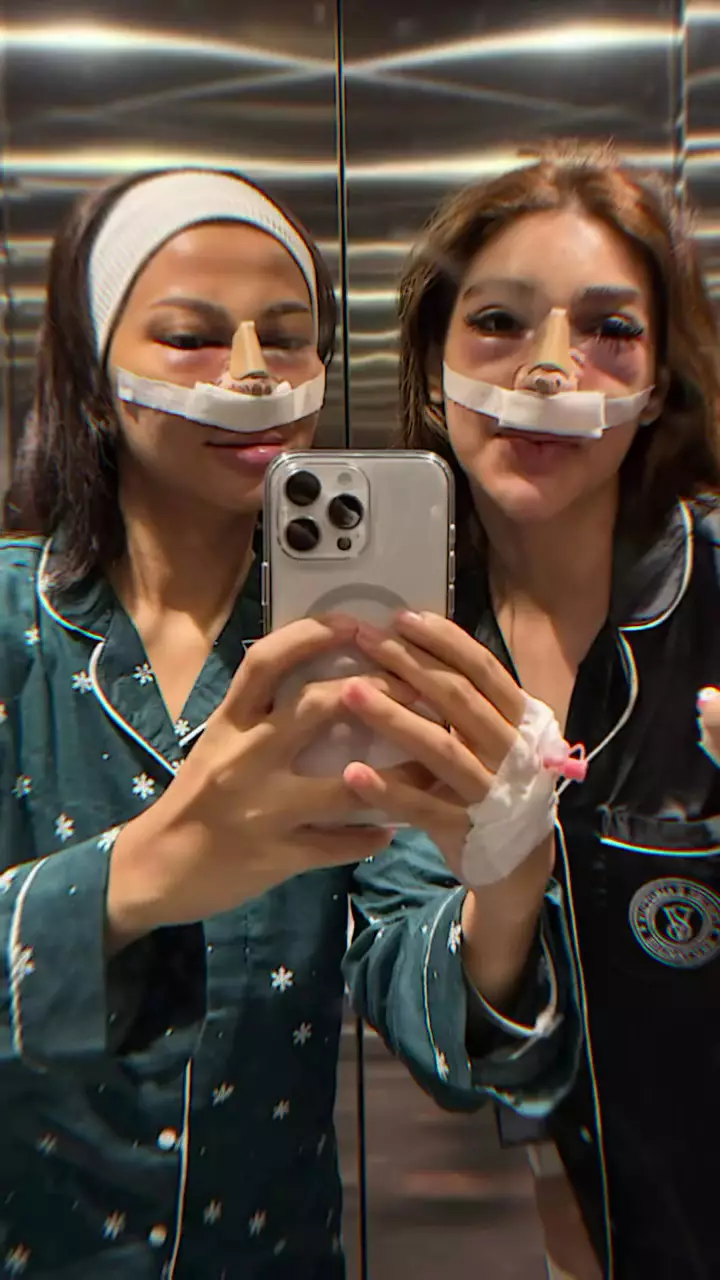 Hanum Mega operasi plastik hidung © 2025 Instagram Hanum Mega operasi plastik hidung © 2025 Instagram