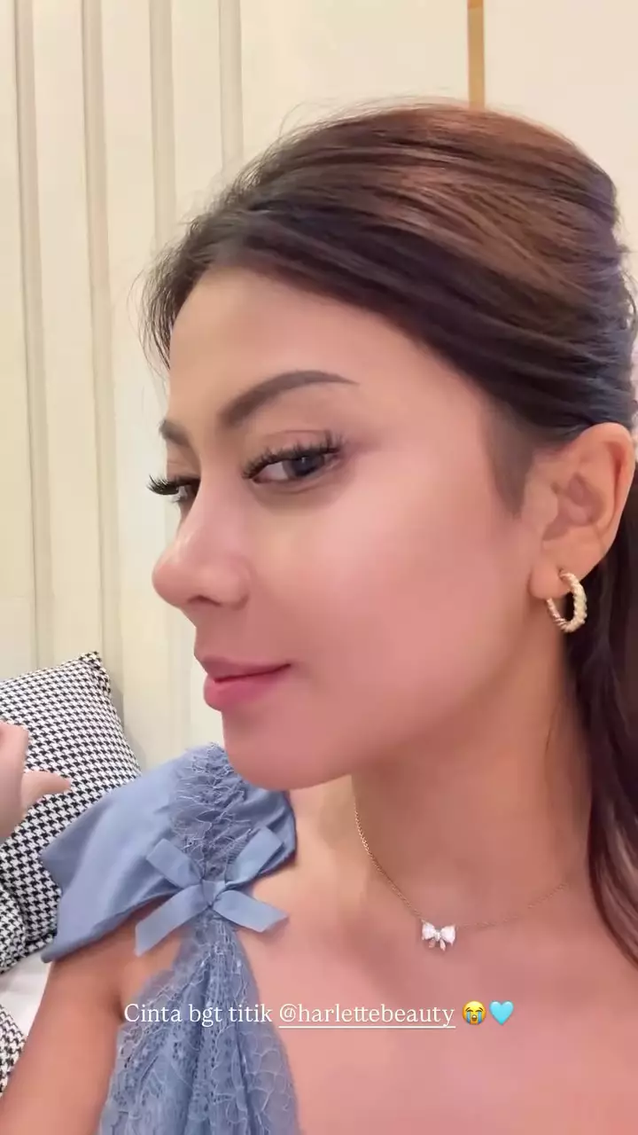 Hanum Mega operasi plastik hidung © 2025 Instagram Hanum Mega operasi plastik hidung © 2025 Instagram