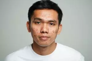 10 Skincare cowok penghilang bekas jerawat harga di bawah Rp 100 ribu