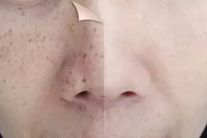 Trik menyamarkan flek hitam agar kulit kembali mulus cuma andalkan 1 jenis topping minuman