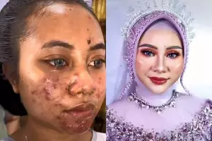 Cewek dengan wajah full jerawat ini dirias jadi pengantin, transformasinya bikin nggak percaya