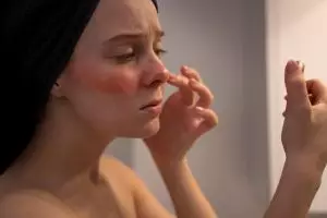 9 Cara mengatasi kurap di wajah tanpa bahan kimia, bisa gunakan kunyit hingga minyak serai