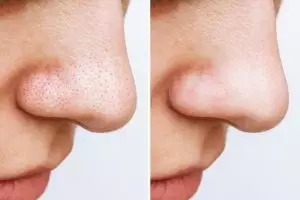 Bukan pakai pasta gigi, ini trik membuat komedo di hidung hilang total pakai kombinasi 2 bahan manis